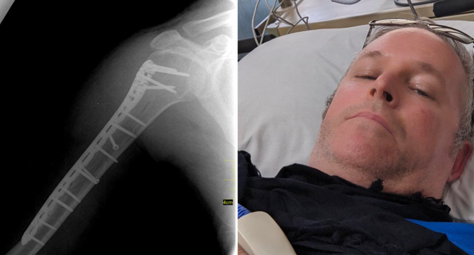 Left image is an X-ray of Curtis Bransby's broken arm. Right image is of Bransby in hospital in Bali.