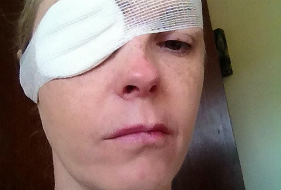 Rachel Foulkes-Davies had to wear an eye patch (Picture: SWNS)
