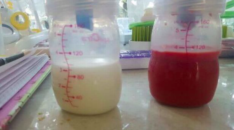 A mum has shared an image of her bloody breast milk to warn others about the early signs of mastitis [Photo: Facebook/The Milk Meg]