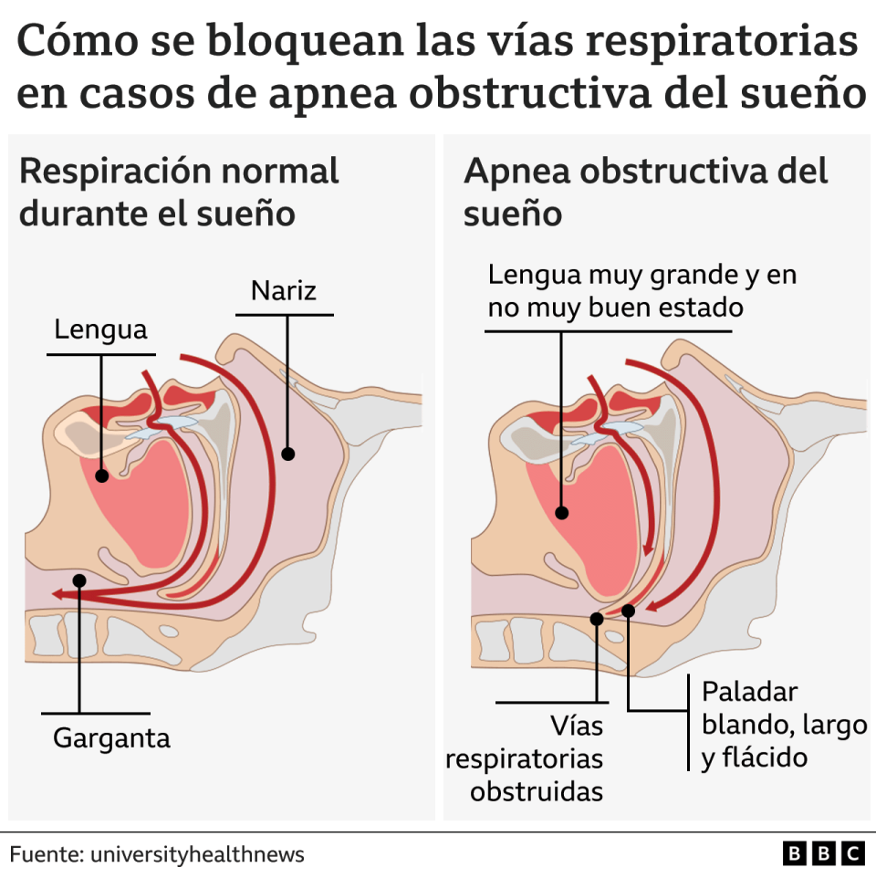 Gráfico que ilustra la respiración normal y la apnea del sueño.