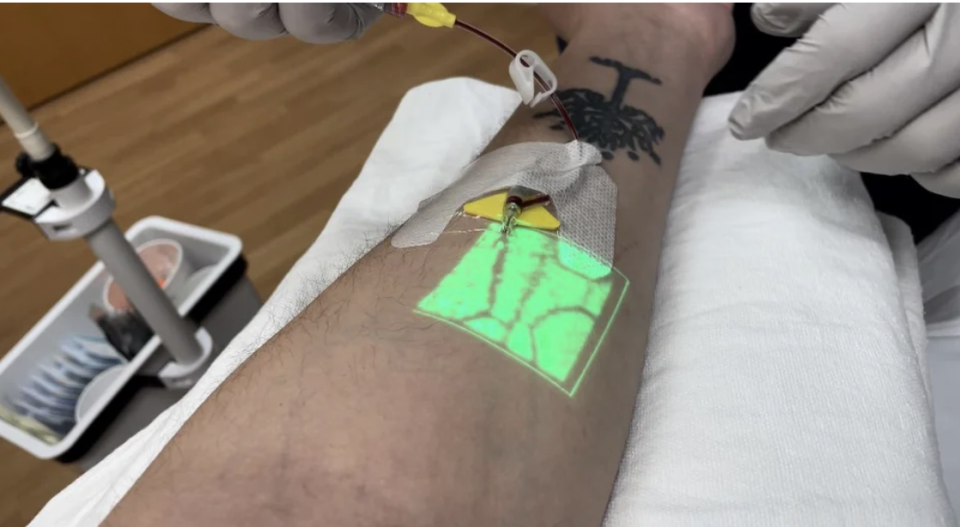 An infrared vein finder on someone's arm