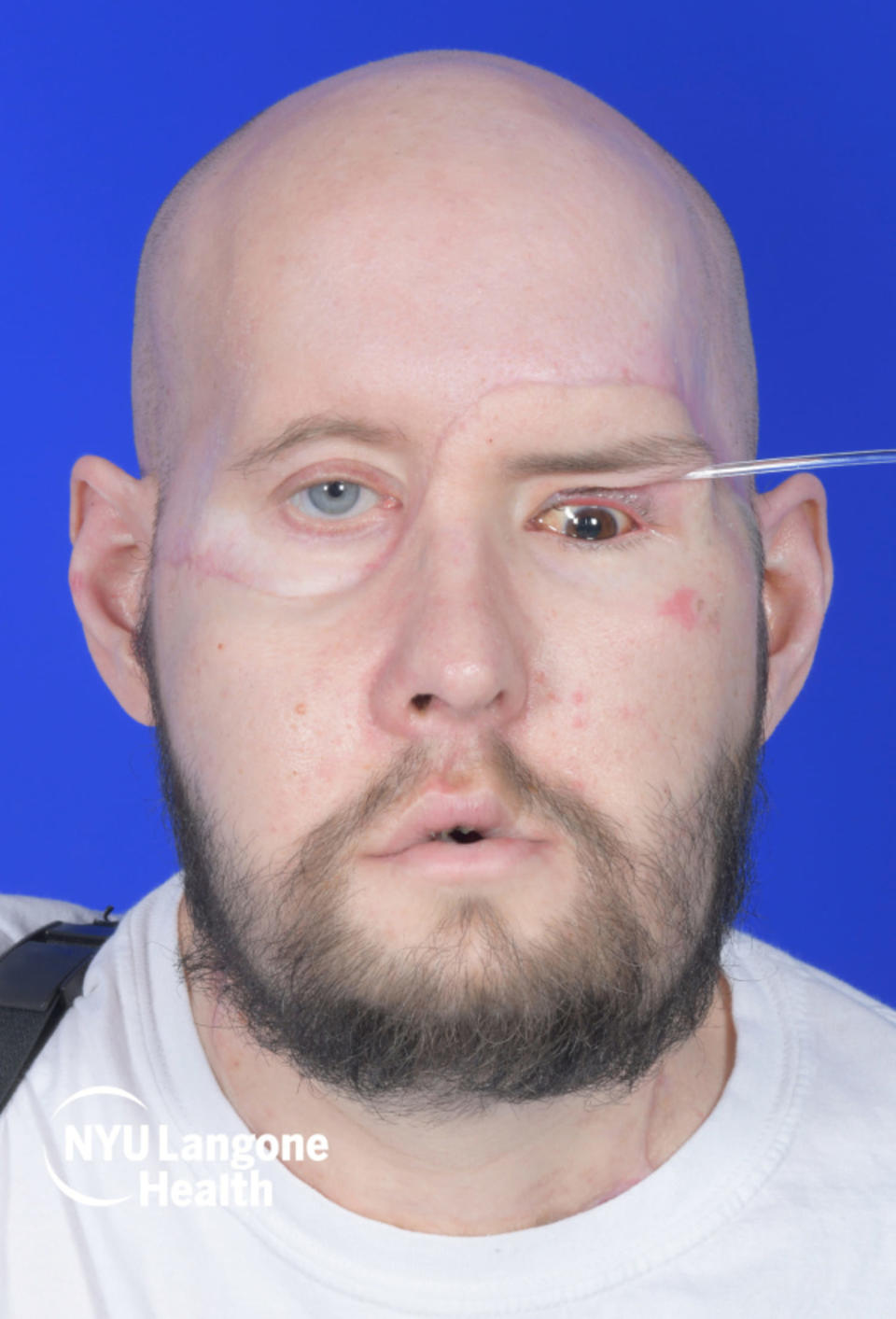 Aaron James after the face and whole eye transplant. (NYU Langone Health)