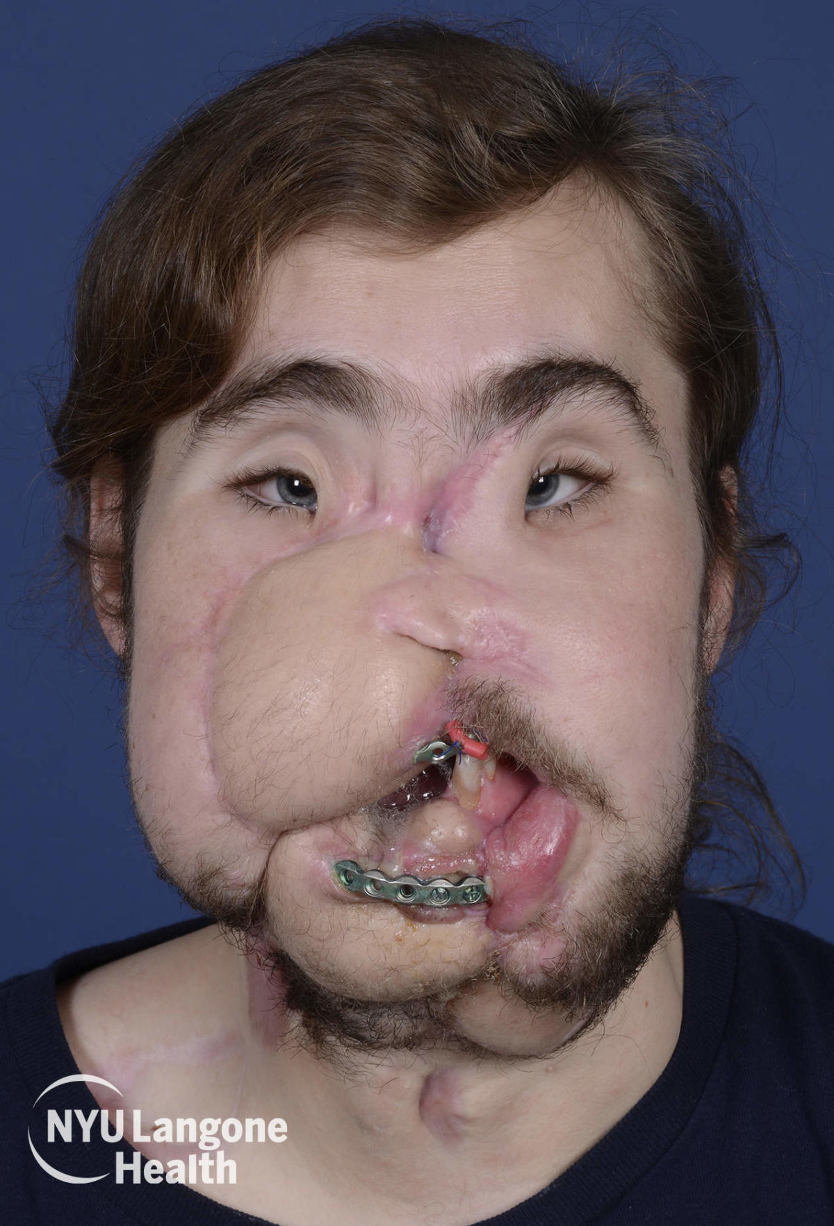 This Man's Face Transplant Story Is Incredibly Inspiring