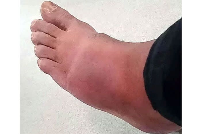 Rezamand's foot ballooned in size. Image: SWNS