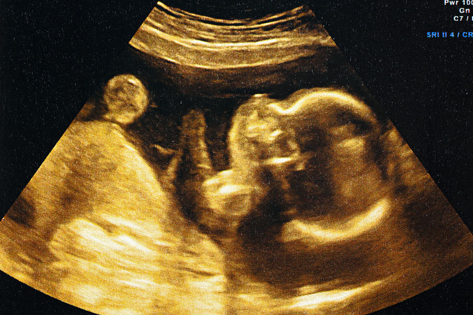 Ultrasound image showing a developing baby in the womb, featured in an article on Sex & Love