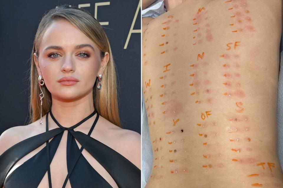 <p>Michael Kovac/Getty; Joey King/Instagram</p> Joey King and her allergy test
