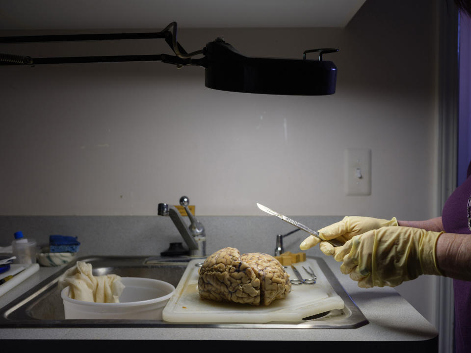 A human brain being examined after it has been fixed in formaldehyde and hardened<span class="copyright">Jarod Lew for TIME</span>