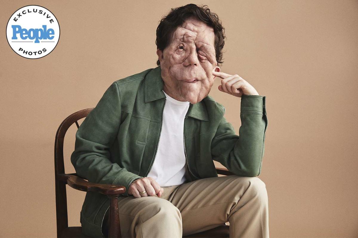 'A Different Man' Star Adam Pearson Says His Facial Disfigurement 'Opened Doors'