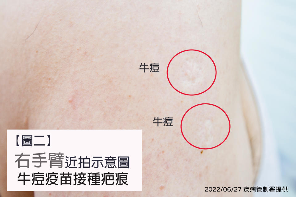 中央流行疫情指揮中心公布卡介苗與牛痘疫苗接種疤痕示意圖。（圖片來源：中央流行疫情指揮中心）