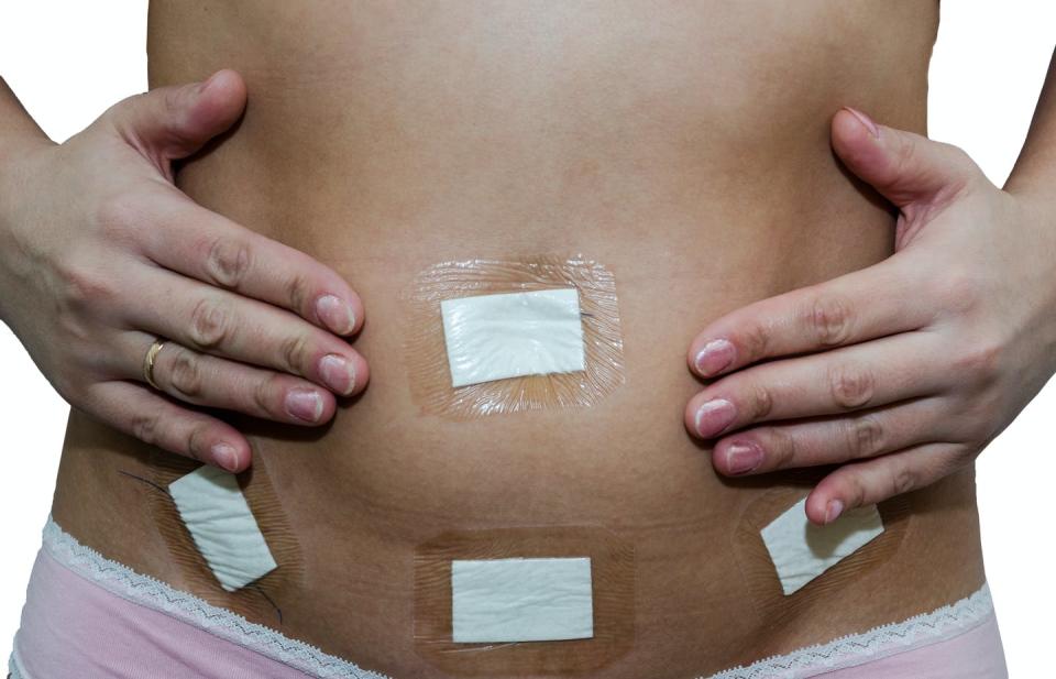 <span class="caption">Sometimes endo will be diagnosed and treated in the same surgery, but this isn’t always the case.</span> <span class="attribution"><a class="link " href="https://www.shutterstock.com/image-photo/bandaid-on-stomach-abdomen-after-laparoscopy-1646031907" rel="nofollow noopener" target="_blank" data-ylk="slk:Shutterstock;elm:context_link;itc:0;sec:content-canvas">Shutterstock</a></span>