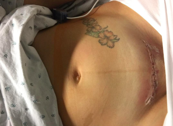 c section scar