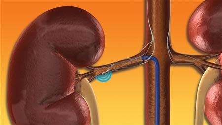 Medtronic's Symplicity renal denervation device is shown being used in kidneys in this handout image provided to Reuters by Medtronic, April 9, 2014. REUTERS/Medtronic/Handout