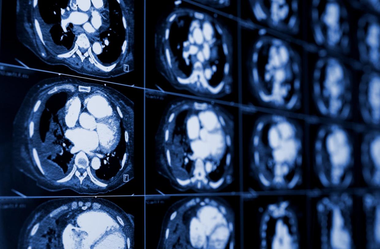 Lung cancer screening can save lives, but it isn't accessible to everyone at risk of developing the disease. <a href="https://www.gettyimages.com/detail/photo/computed-tomography-of-the-chest-medical-background-royalty-free-image/470844146" rel="nofollow noopener" target="_blank" data-ylk="slk:sudok1/iStock via Getty Images Plus;elm:context_link;itc:0;sec:content-canvas" class="link ">sudok1/iStock via Getty Images Plus</a>