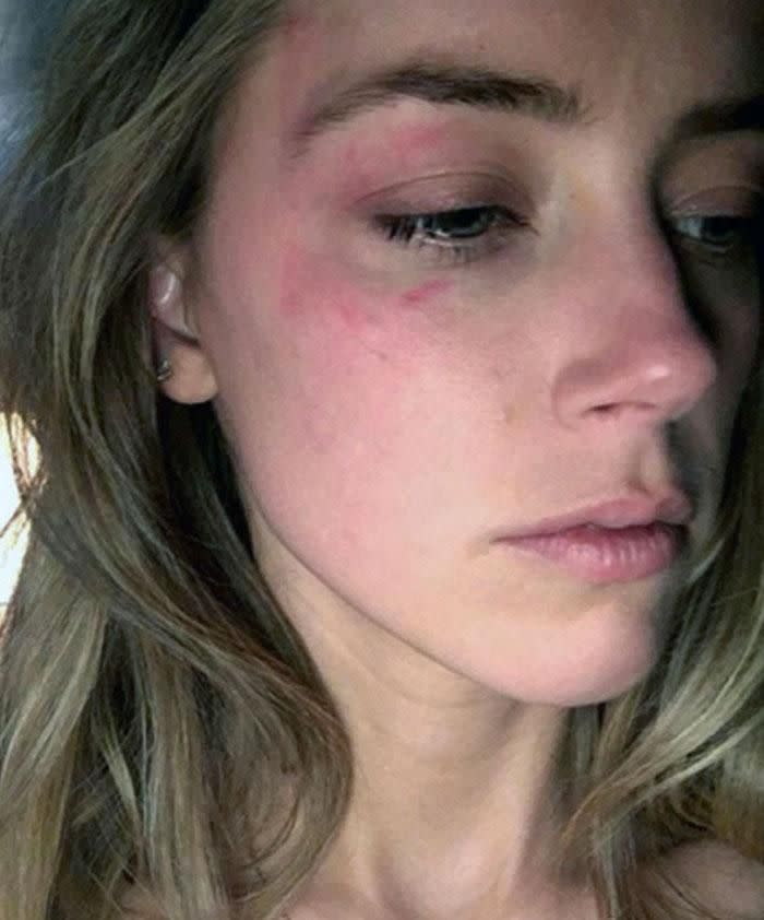 Amber Heard shows bruises she claims were inflicted by Johnny Depp. Photo: Splash News