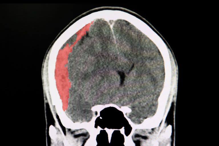 El hematoma subudural se produce cuando se acumula sangre entre el cráneo y la membrana cerebral, en este caso, es el que se ve en color rojo y corresponde a un traumatismo por accidente de tránsito