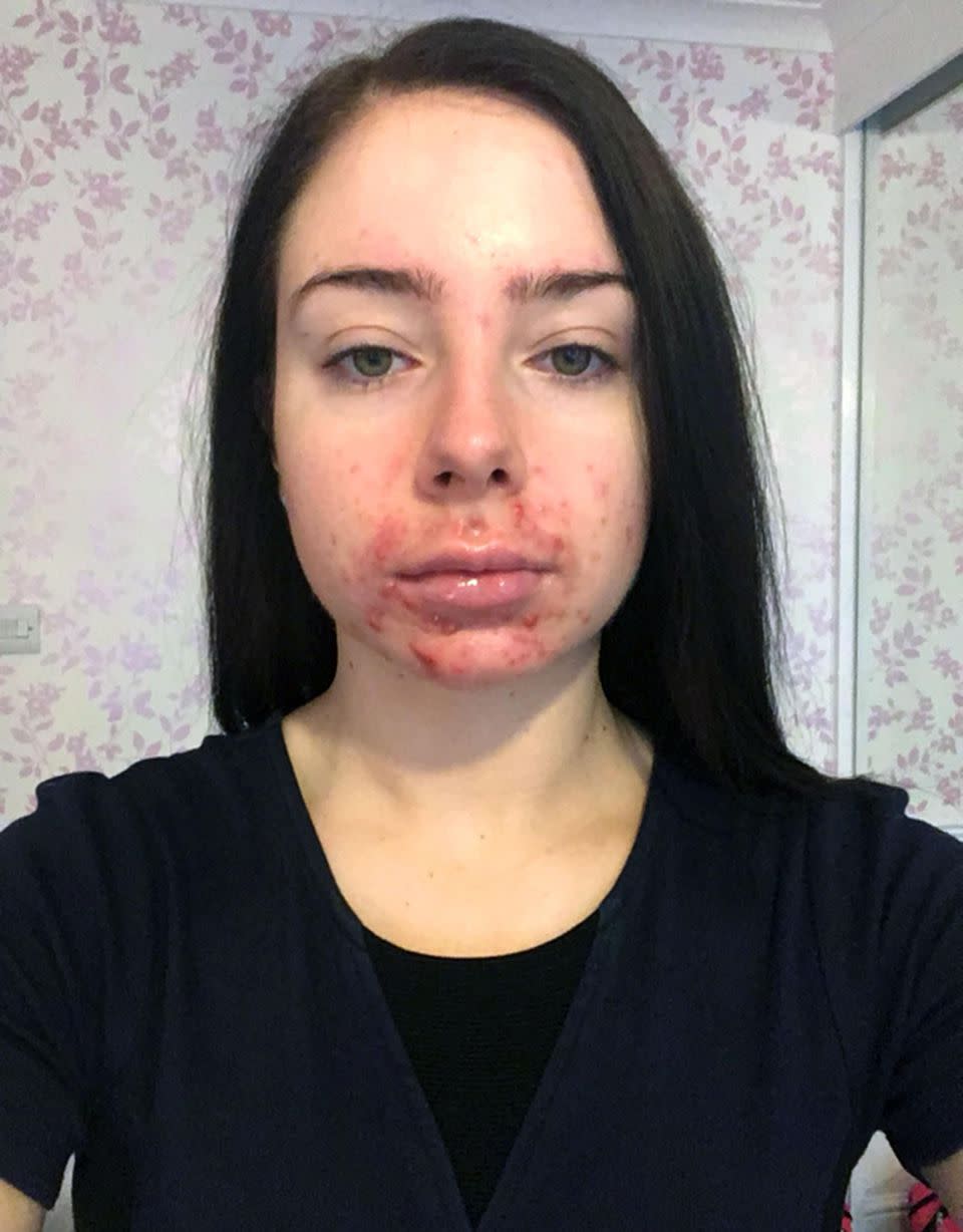 Mollie Cowin's acne was so bad she says her boyfriend was 