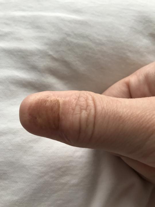 Karolina Jasko had nail melanoma (Courtesy Karolina Jasko)