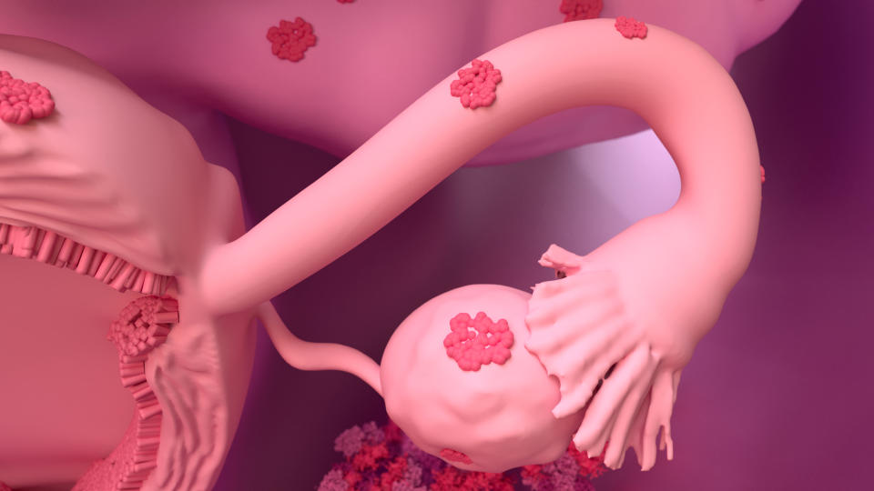 小部分子宮內膜或會在子宮外面的器官生長，結果形成子宮內膜異位。