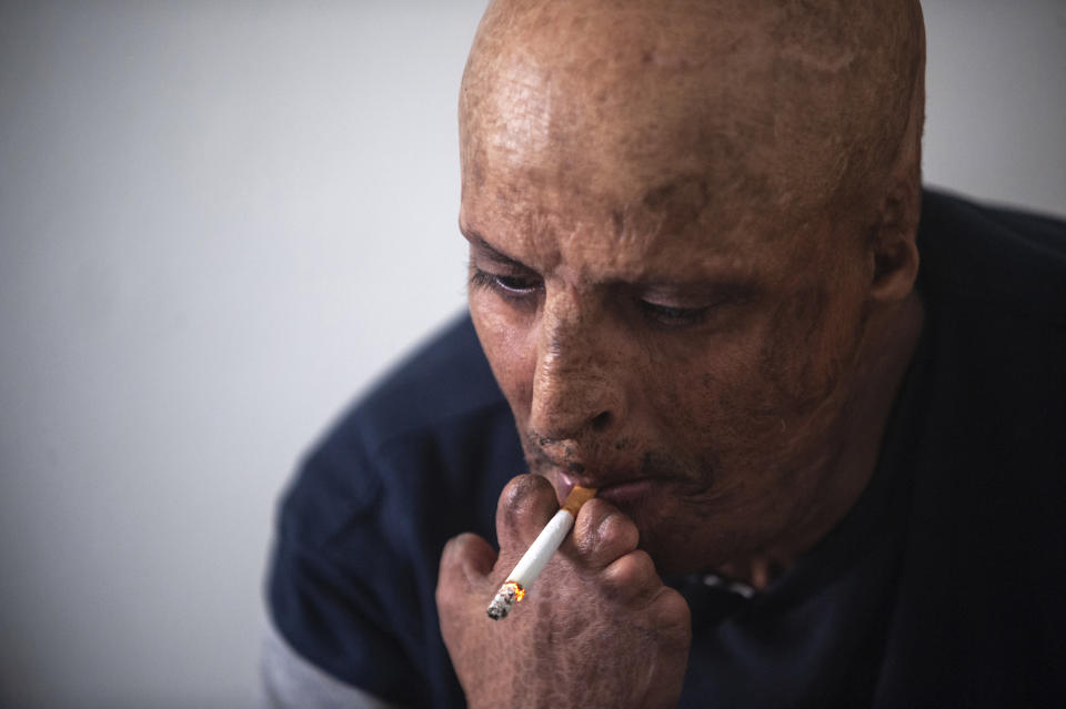 Hosni Kalaia, 49, smokes a cigarette in his house in Kasserine, Tunisia, Friday Dec.11, 2020. He's among hundreds of Tunisians who have turned to the desperate act of self-immolation in the past 10 years as a form of protest. Kalaia spent three years in a hospital and then a private clinic recovering from his burns. (AP Photo/Riadh Dridi)