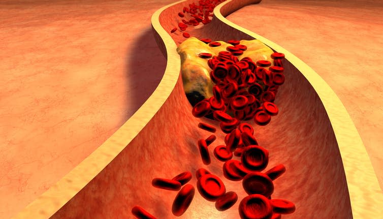 <span class="caption">A clogged artery with platelets and cholesterol plaque.</span> <span class="attribution"><a class="link " href="https://www.shutterstock.com/image-illustration/clogged-artery-platelets-cholesterol-plaque-concept-259675388" rel="nofollow noopener" target="_blank" data-ylk="slk:Shutterstock;elm:context_link;itc:0;sec:content-canvas">Shutterstock</a></span>