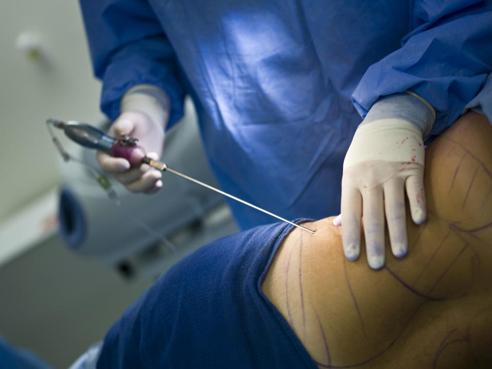 A person in surgical attire performs a liposuction procedure on a patient's marked back using a cannula