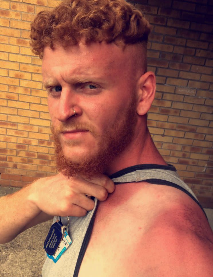 Greg Binnie posts to Twitter to warn people about severe sunburn.