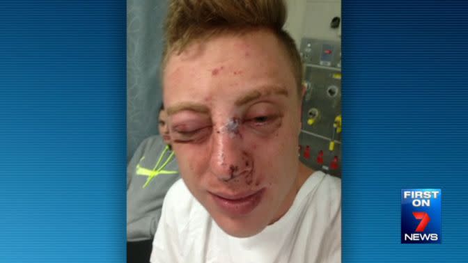 Jeremy Hawthorne suffered a broken nose and multiple lacerations to his face. Photo: 7 News
