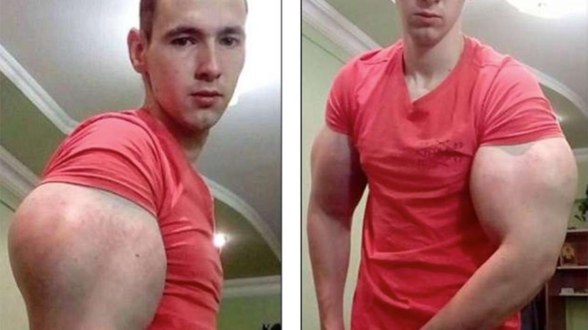 The Weird World of Synthol Bodybuilders