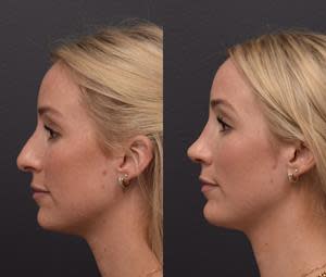 Ultrasonic Rhinoplasty Results, 4 Weeks Post-Surgery, Female, Age 30