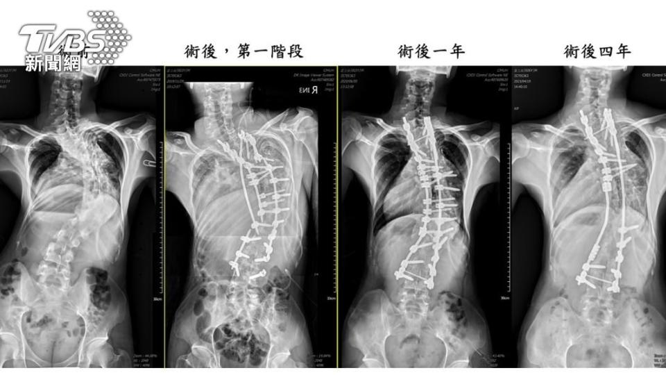 「龜背少年」番玉磊成功手術後每年定期追蹤，均維持良好狀態。(照片中醫大附醫提供)