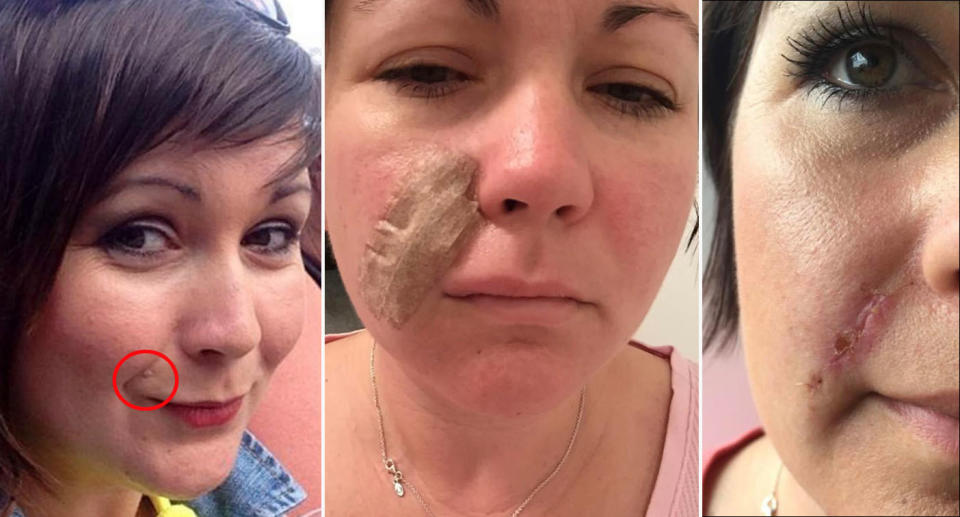 Australian woman gets basal cell carcinoma (BCC) skin cancer cut out of her face. 