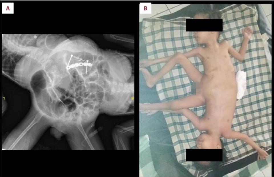 “The rarity of ischiopagus-tripus conjoined twins complicates the surgical separation, owing to the lack of cases and high complexity,” the authors wrote in the American Journal of Case Reports. Am J Case Rep, 2024