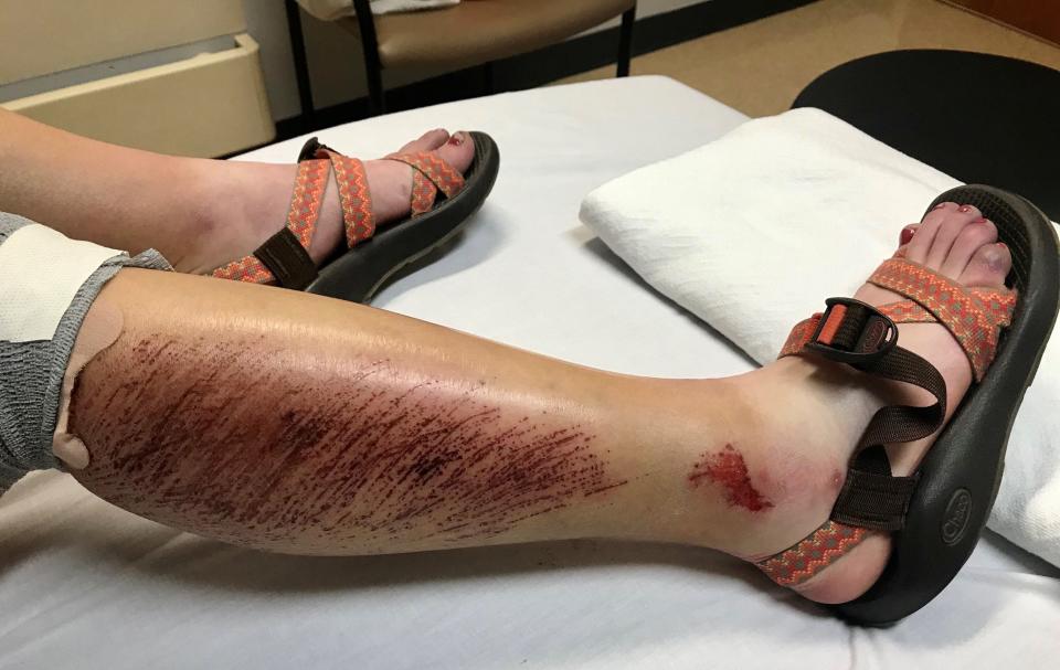 Lauren Bailey's injured legs.