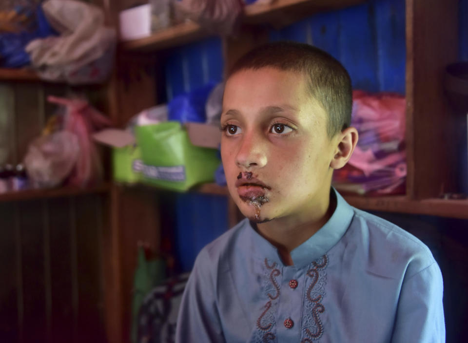 A Pakistani Kashmiri boy Mazhar Hussain, shows his injuries he received when Indian forces fired on Nosehri village on the Line of Control that divides Kashmir between Pakistan India, near Muzaffarabad, Pakistan, Sunday, Aug. 4, 2019. Tensions have soared along the volatile, highly militarized frontier between India and Pakistan in the disputed Himalayan region of Kashmir, as India deployed more troops and ordered thousands of visitors out of the region. (AP Photo/M.D. Mughal)