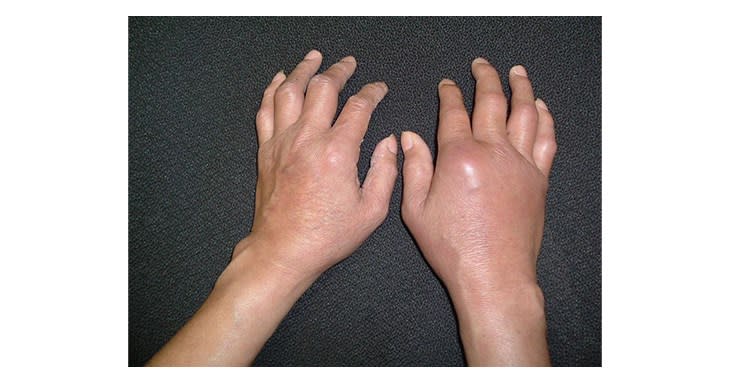 圖二、類風溼性關節炎雖有腫脹，少有真的發紅，多半侵犯手部，所謂對稱也不是百分之百，此病人的對稱表現於雙側指間關節，右側有比較明顯的指掌關節腫脹。（圖片提供／亞東醫院）