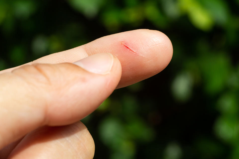 Woman has been cut index finger and scar skin on hand, Close up & Macro shot, Asian Body skin part, Healthcare concept, Bokeh green garden background