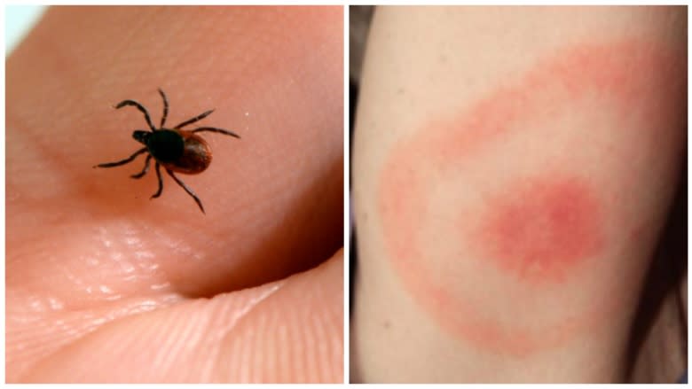 Lyme disease diagnosis may be delayed due to 'mysterious' symptoms, doctor warns