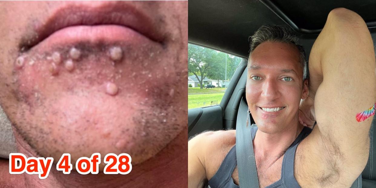 A collage shows a close up of Steele's rash on his face next to a picture of him smiling showing a band-aid over where he got his vaccination.