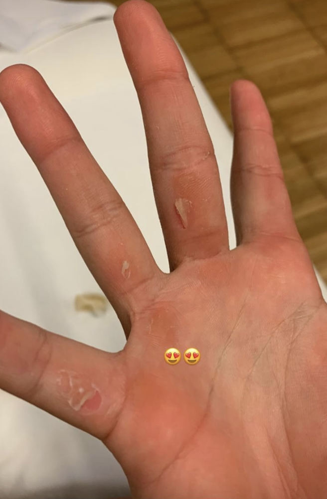 Amanda Anisimova showed the blisters she was struggling with to her fans on Instagram.