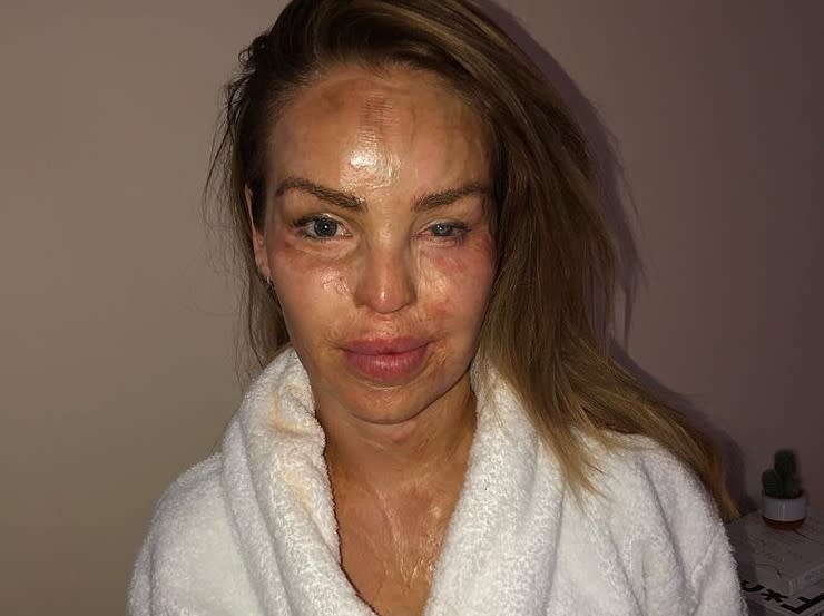 Katie Piper shares recovery photo after having surgery on her "bad eye" (Katie Piper/Instagram)