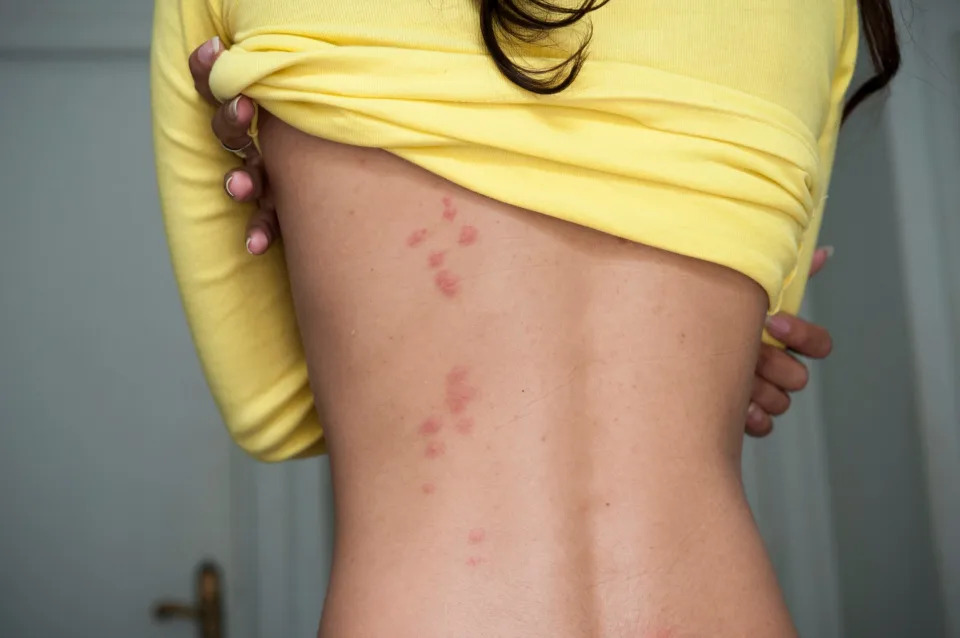 Bedbugs feed on blood and leave itchy bite marks behind.