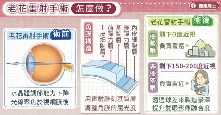 老花雷射手術9大QA