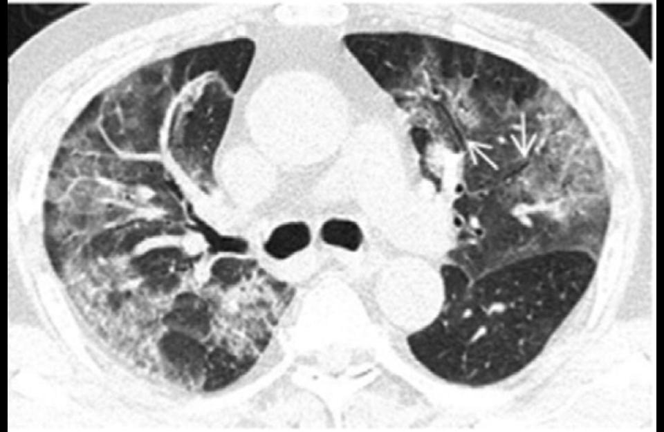 CT scan coronavirus lungs