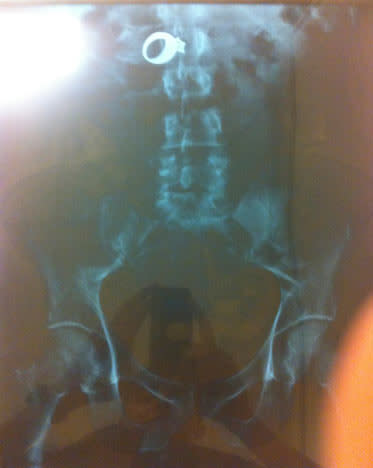 Shocking X-Rays