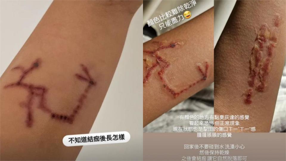 阿圓3度除刺青「驚悚傷口照」流出！親曝「這部位」超有感：像被火柴燙