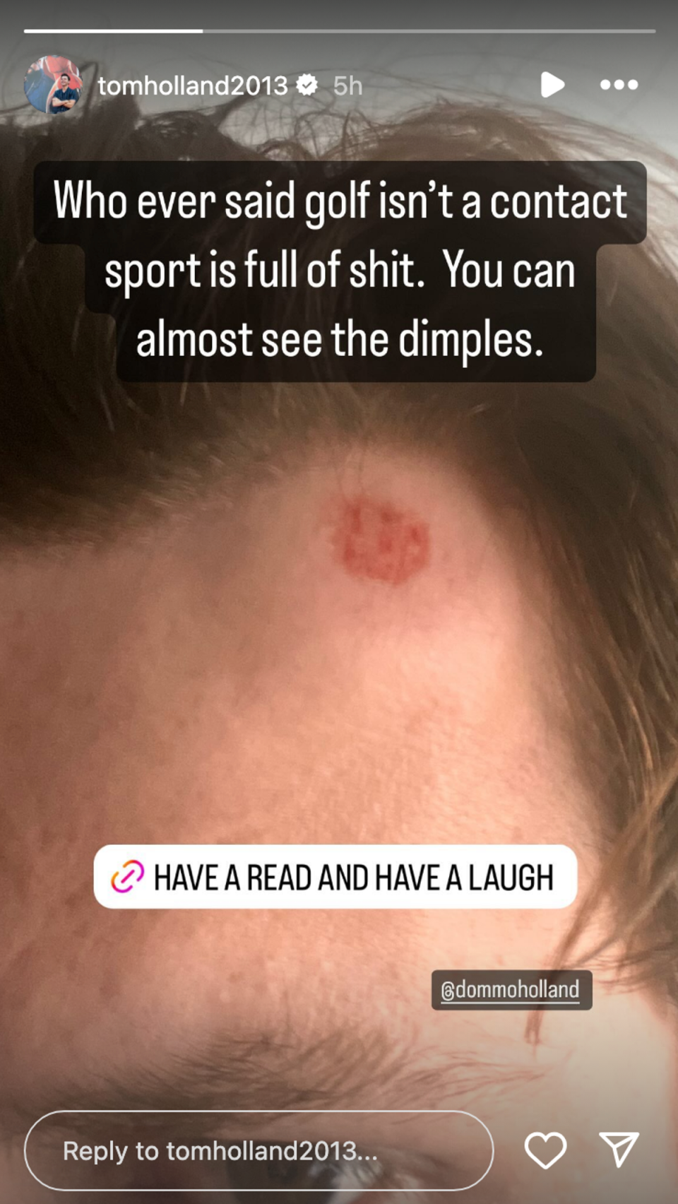 Tom Holland shares close-up of his golf ball injury as Zendaya walks the Met Gala red carpet (Instagram / Tom Holland)