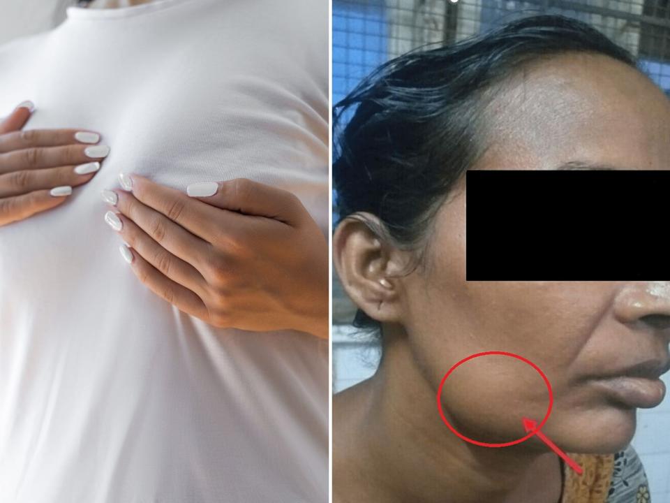 A stock image showing a woman checking her breast for cancer, beside another image showing a woman whose cancer had spread to her jaw.