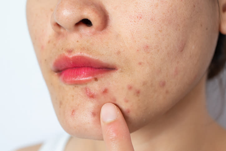 Hierbas que ayudan a combatir el acné