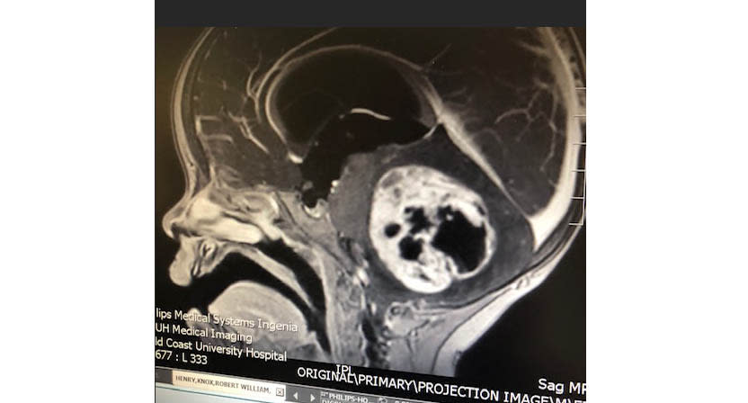 A photo of Knox's MRI scan when he was first diagnosed. Source: supplied 