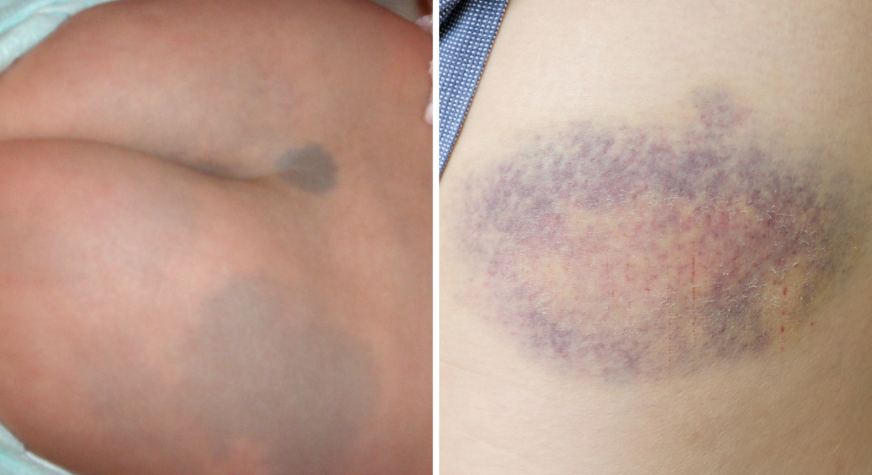 There are a few key differences between a blue spot birthmark and a bruise. (Abby Lu / Wikimedia Commons / Getty Images)